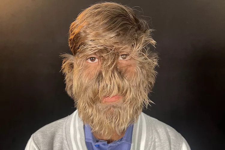 Teen with Rare Condition Wins Guinness World Record for Hairiest Face — 201 Hairs per Centimeter: ‘Proud of Me